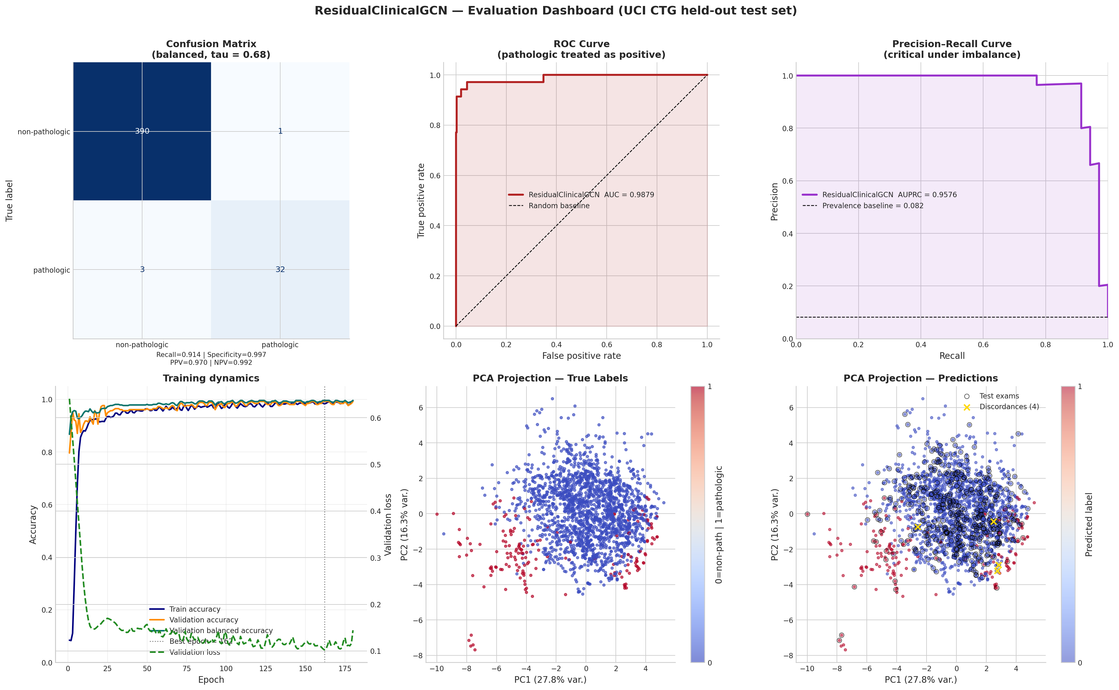 Six-panel biomedical evaluation dashboard showing confusion matrix, receiver operating characteristic (ROC), precision-recall (PR) behavior, training dynamics, and principal component analysis (PCA)-space localization of true labels and prediction discordances for the integrated residual clinical model.